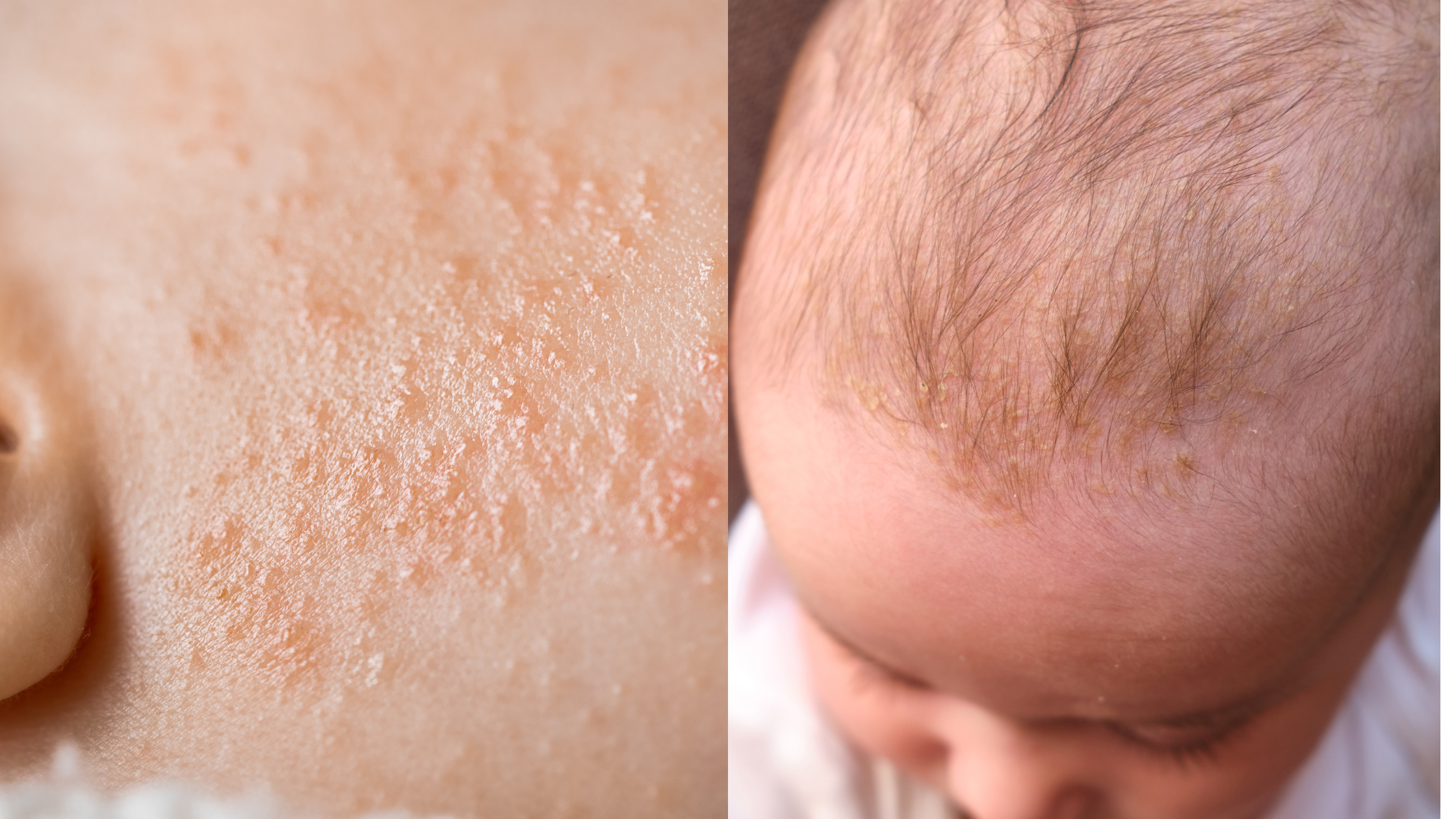 What Are The Differences Between Eczema and Other Skin Rashes?