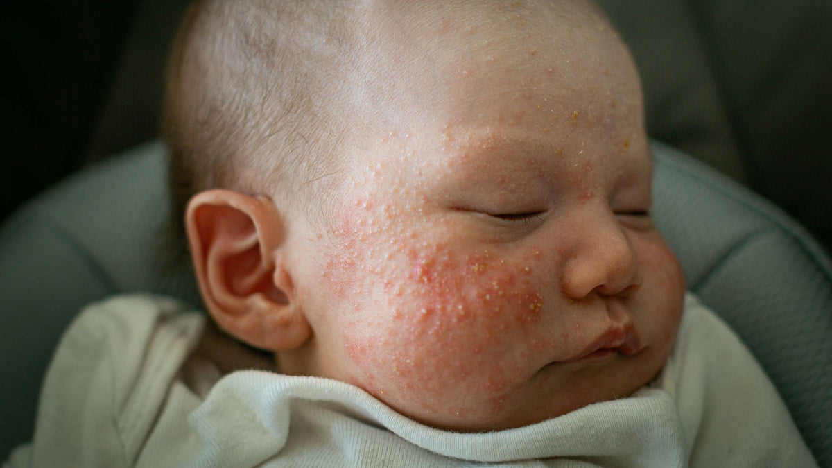Essential oils shop for baby acne