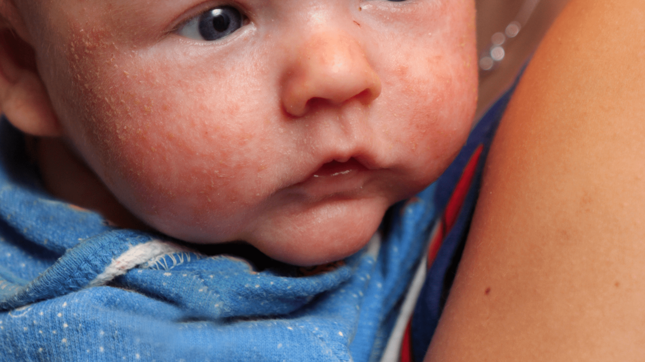 Eight Facts About Eczema All Parents Should Know