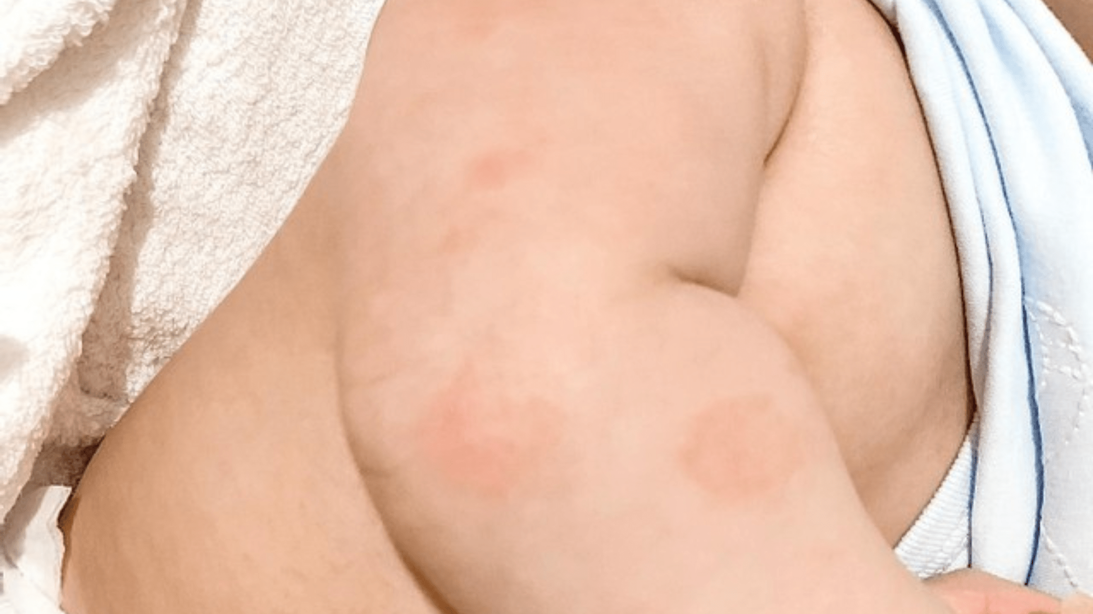 Uncover the Surprising Connection: Iron Deficiency and Its Impact on Eczema