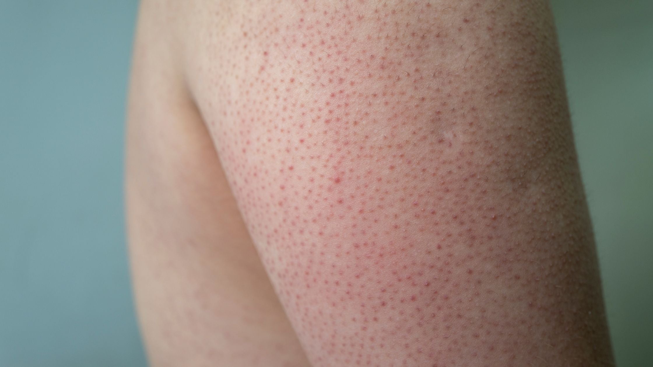 What Is Keratosis Pilaris?