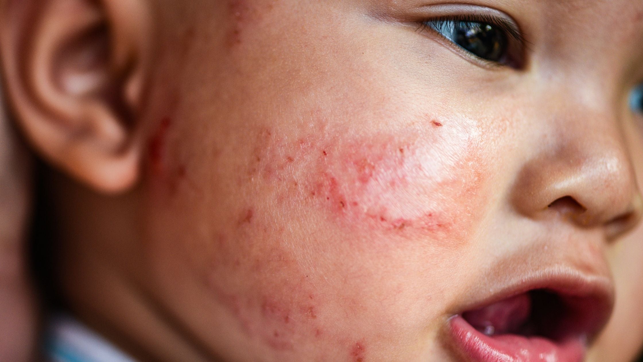 Is My Child's Eczema Infected?