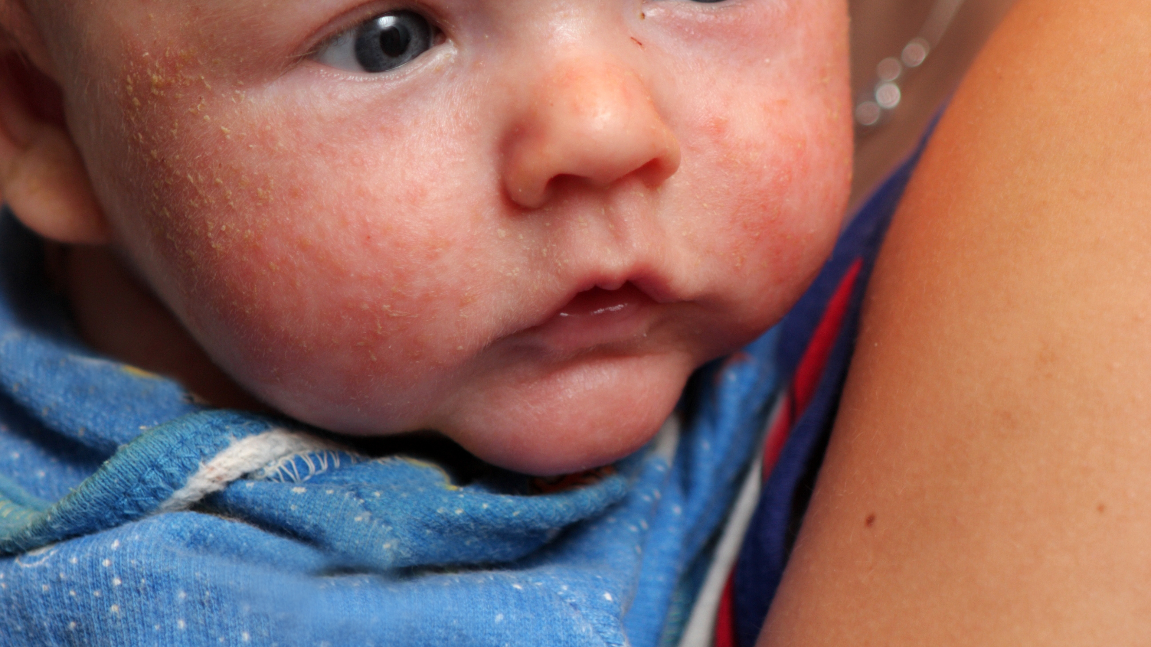 Eight Facts About Eczema All Parents Should Know