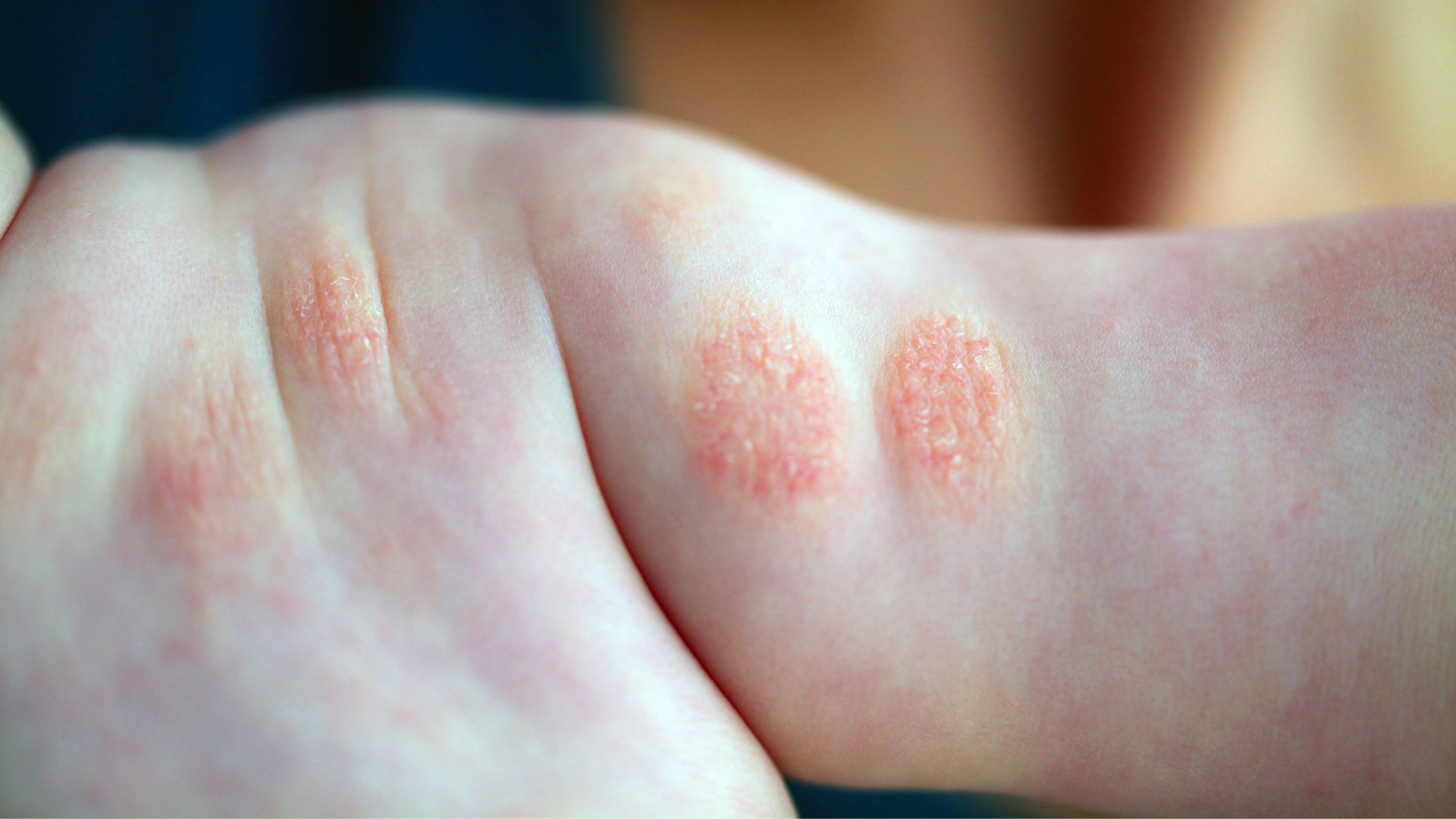 Will My Child Grow Out of Their Eczema?