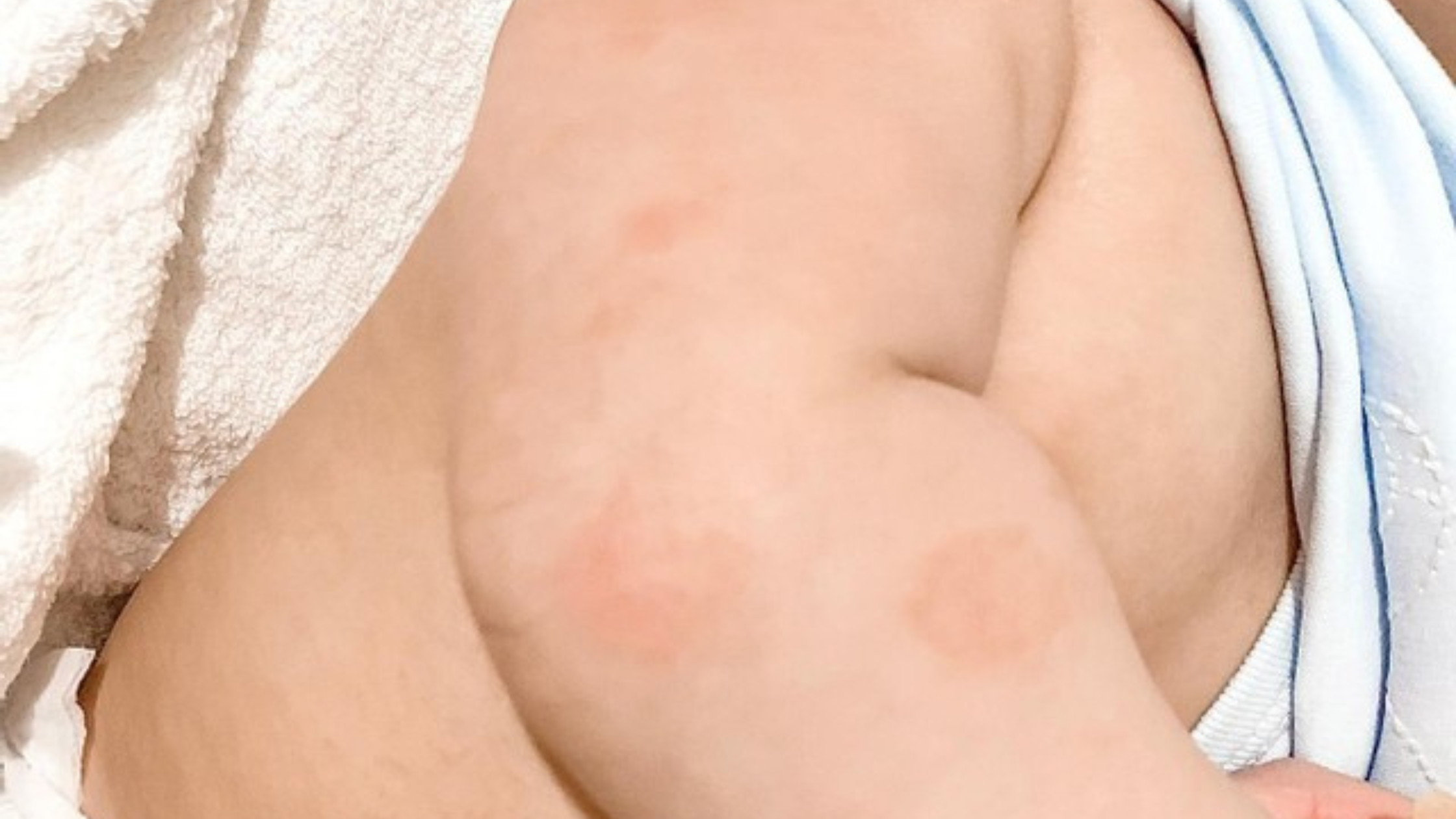 Uncover the surprising connection: Iron deficiency and its impact on eczema