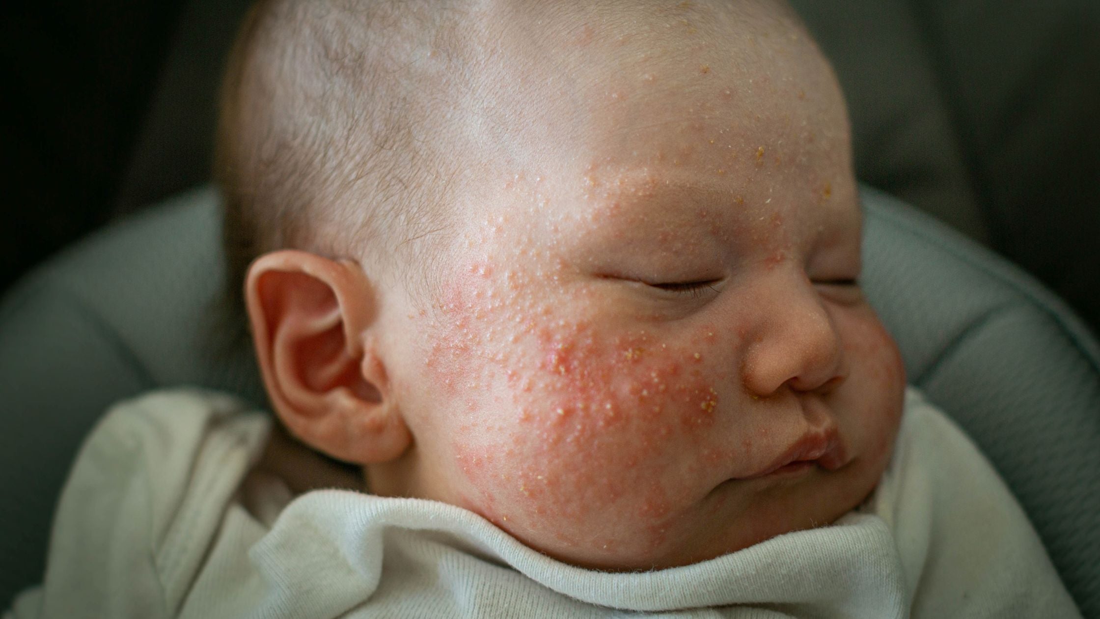 My Child Has Baby Acne – What Is It and How Do I Help It?